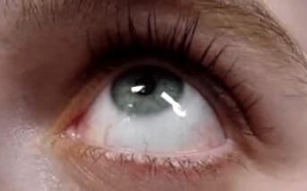 Horizontal Gaze Nystagmus Eyeball